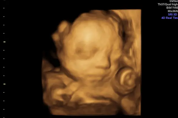 3D-/4D-Ultraschallbild eines Ungeborenen, zeigt detaillierte Darstellungen und Bewegungen während der Schwangerschaft.