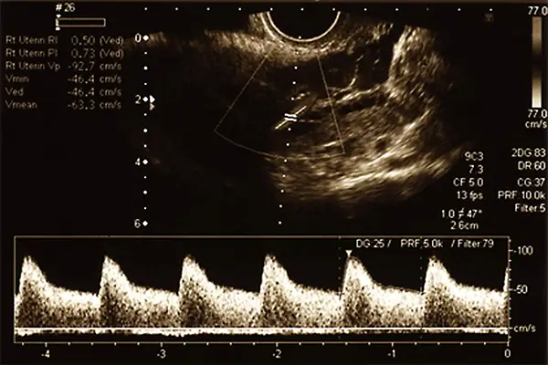Ultraschallbild einer Schwangeren während einer Dopplersonografie, zeigt die Blutzirkulation des Ungeborenen und mütterliche Gefäße.