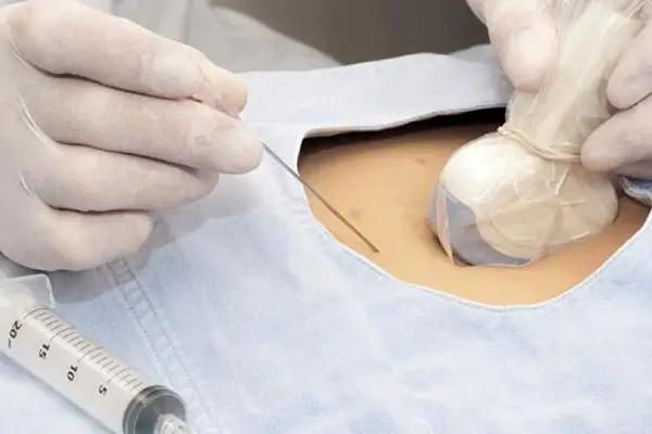 Ultraschallgeführte Fruchtwasserentnahme zur genetischen Untersuchung des Ungeborenen, ein wichtiger Bestandteil der Pränataldiagnostik.