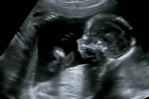 Ultraschallbild eines Ungeborenen während des Erst-Trimester-Screenings